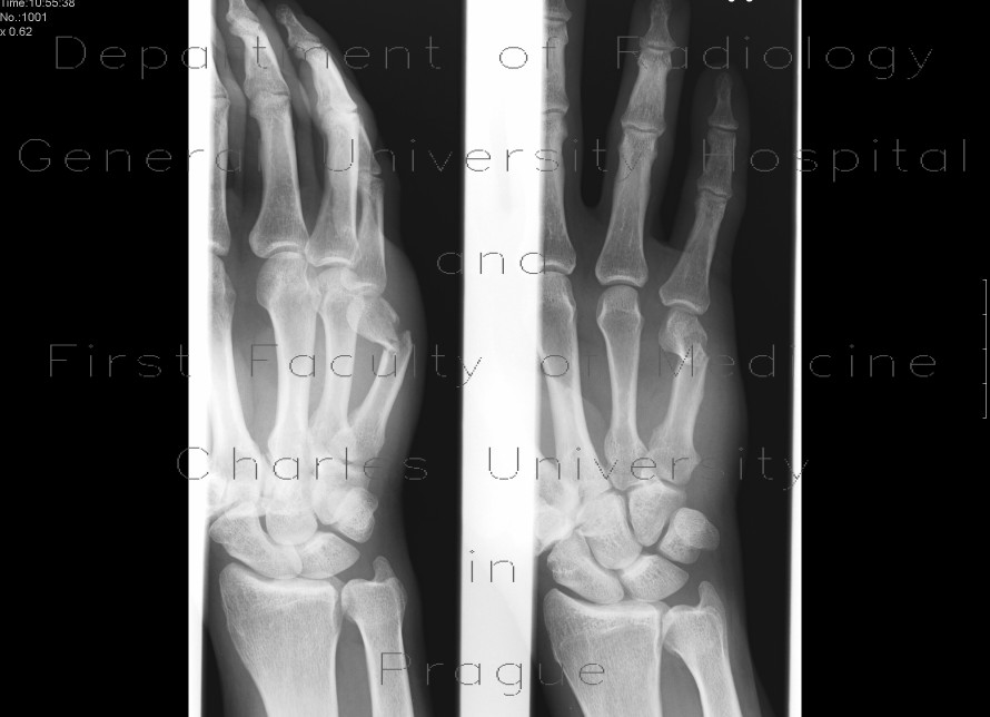 Radiology image - Subcapital fracture of the fifth metacarpal, Boxer
