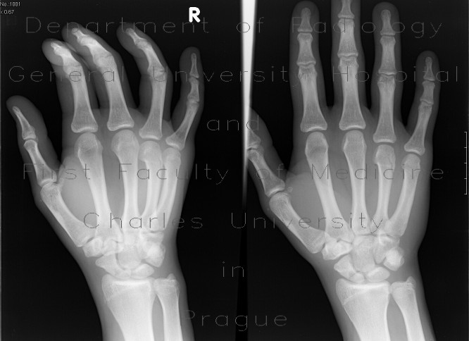 Subcapital fracture of the fourth metacarpal bone