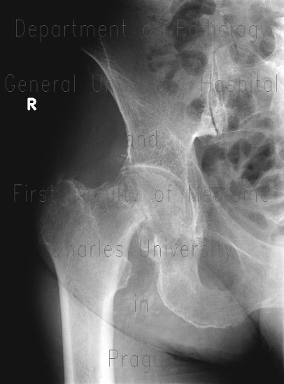 Subcapital fracture of the left femur