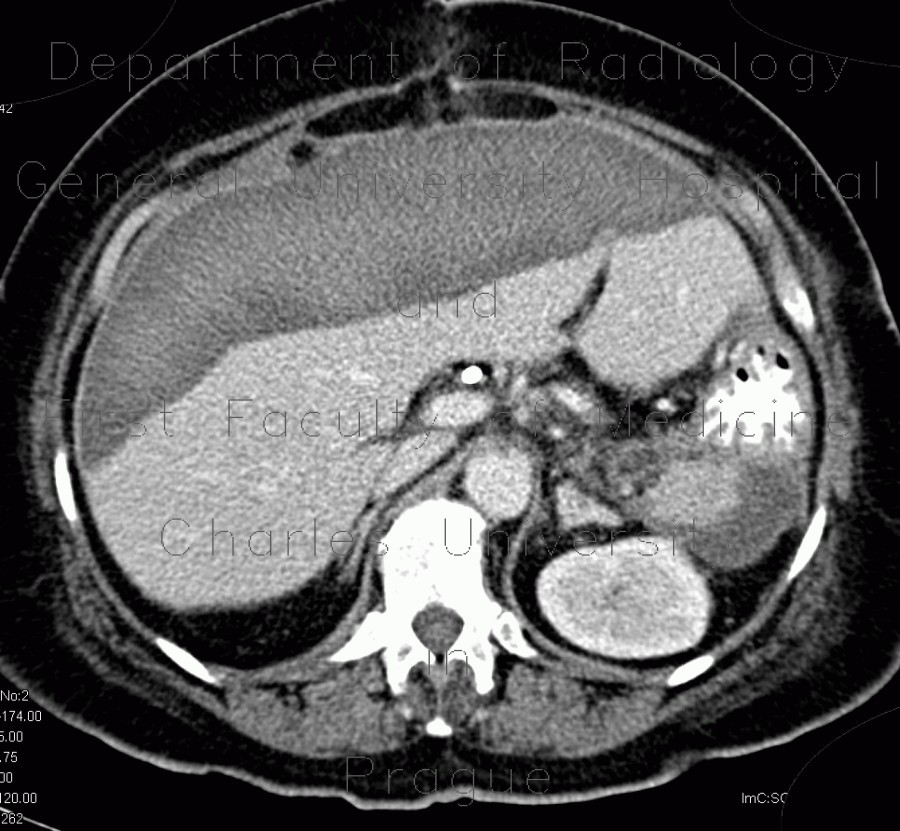 Subcapsular hematoma of liver, liver hematoma