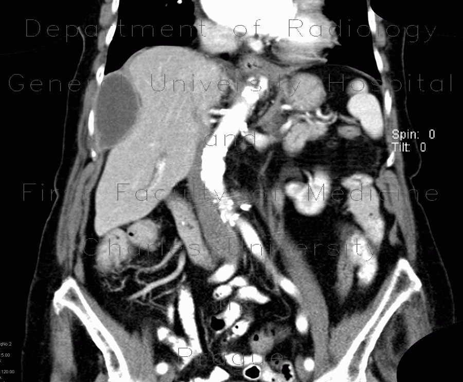 Radiology image - Subdiaphragmatic abscess, abscess: Abdomen, Liver, Peritoneal cavity: CT - Computed tomography