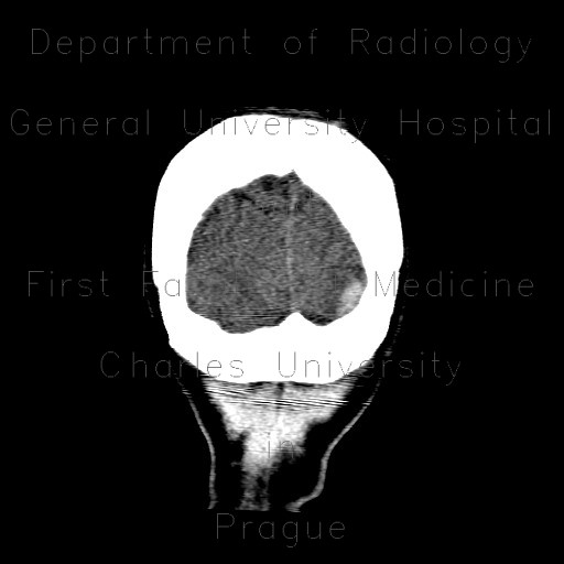 Radiology image - Subdural hemorrhage, minute: Brain, Brain: CT - Computed tomography
