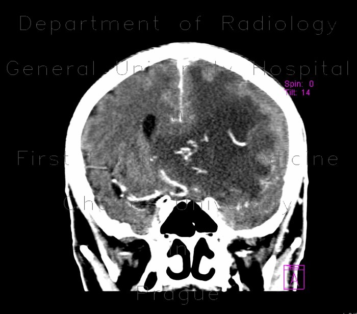 Radiology image - Subfalcine herniation, brain edema: Brain, Brain: CT - Computed tomography