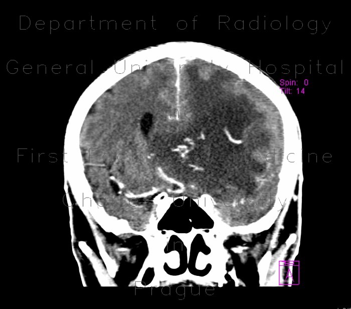 subfalcine herniation