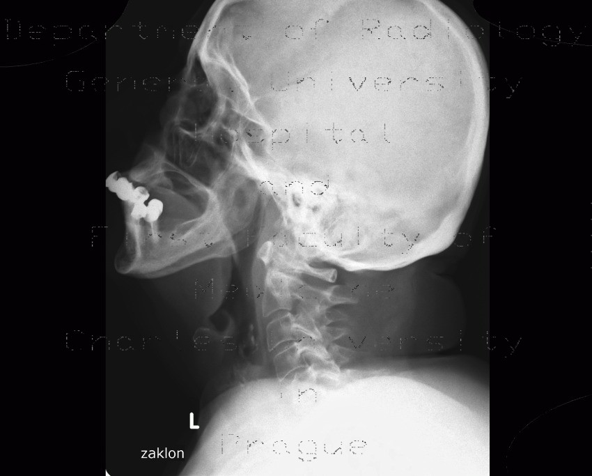 Subluxation in atlantoaxial joint in rheumatoid arthritis