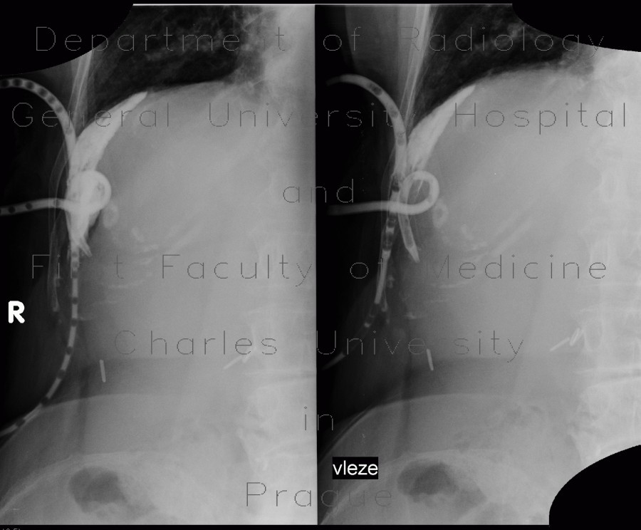 Subphrenic abscess, drainage, pig-tail, leak of contrast, fistulography