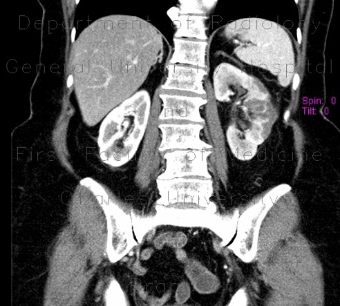 Radiology image - Subsegmental kidney infraction or focal nephritis: Abdomen, Kidney and adrenals: CT - Computed tomography