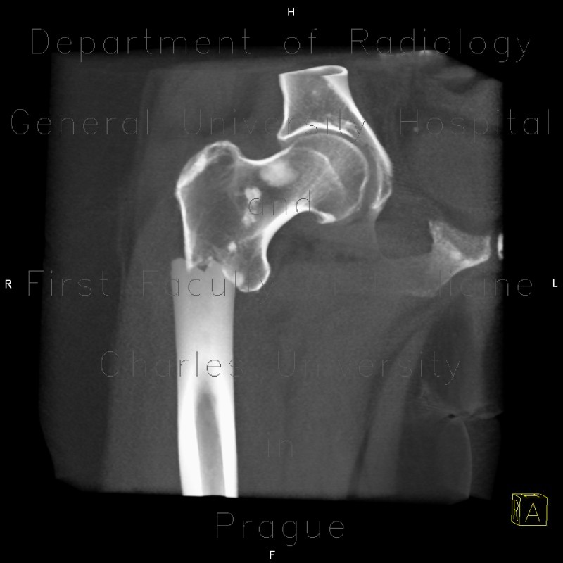 Radiology image - Subtrochanteric fracture of femur, pathologic fracture, bone metastasis, VRT: Extremity, Bone: CT - Computed tomography