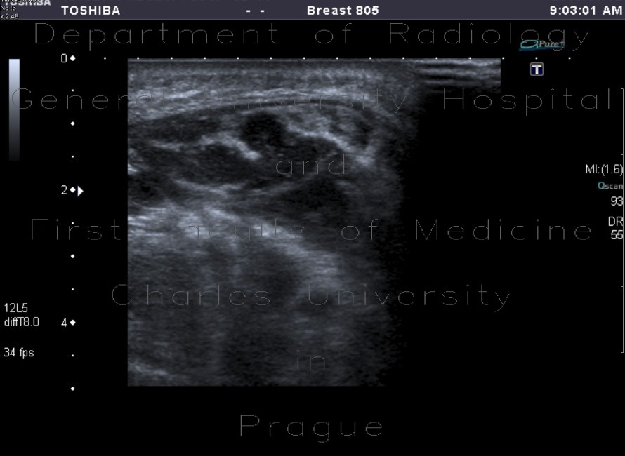 Radiology image - Suppurative sialoadenitis: Head and Neck, Oral cavity: US - Ultrasound