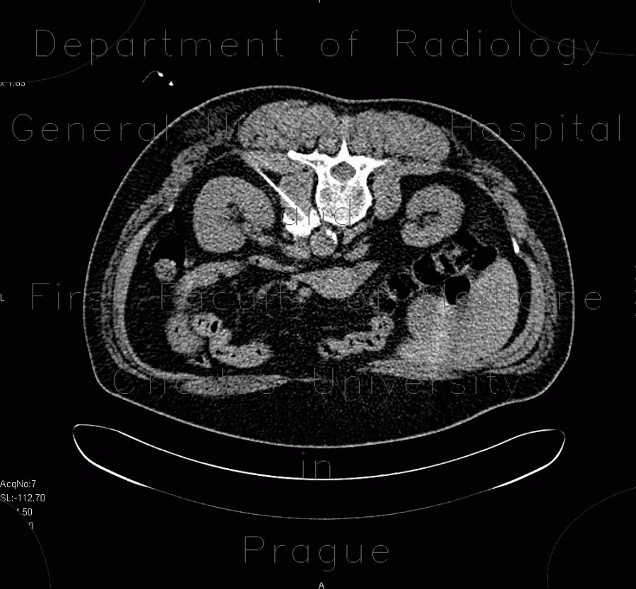 Radiology image - Sympatectomy, alcohol ablation of the coeliac ganglion, CT guided: Abdomen, Interventional, Soft tissue: CT - Computed tomography