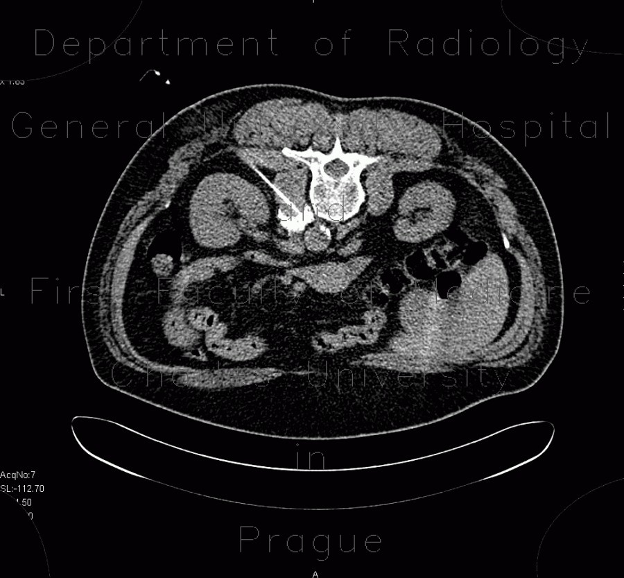 Sympatectomy, alcohol ablation of the coeliac ganglion, CT guided