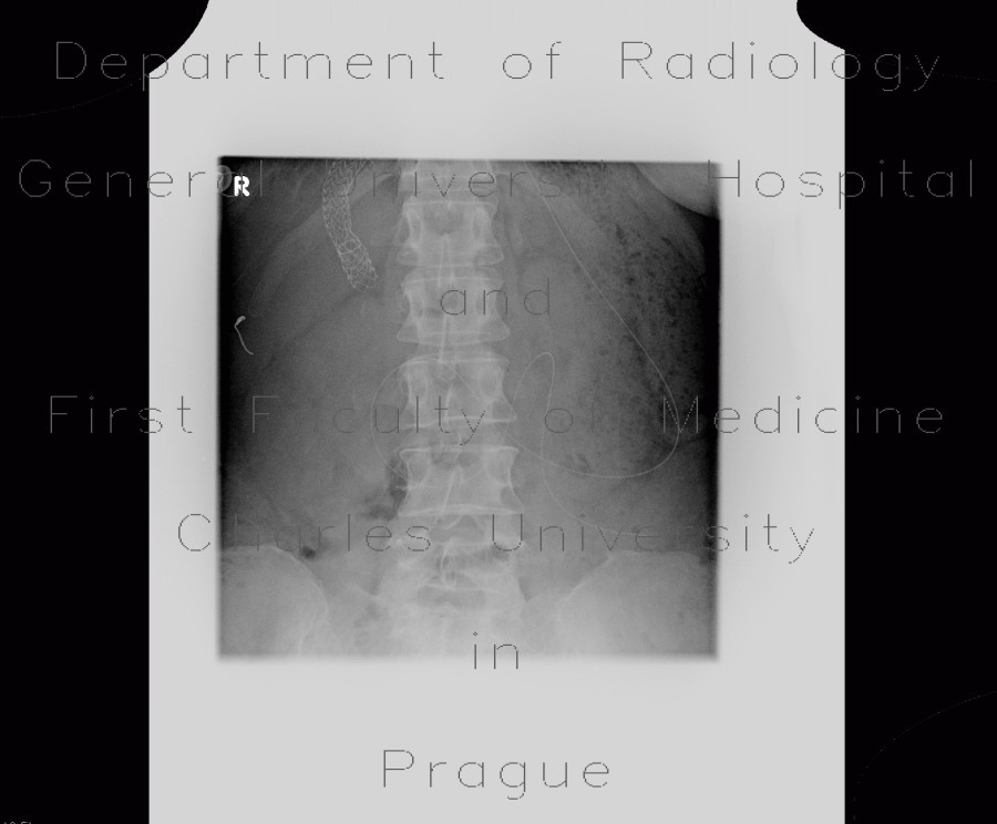 TIPSS, transjugular portosystemic stent-shunt, nasojejunal tube