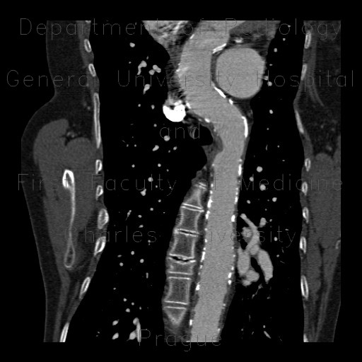 Takayashu arteritis