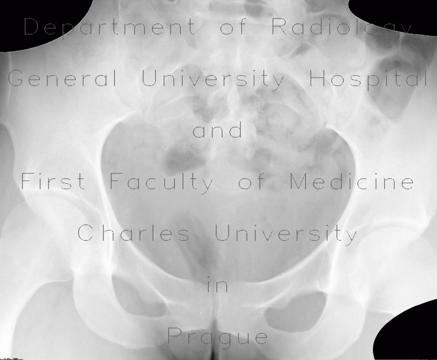 Tampon on plain radiograph