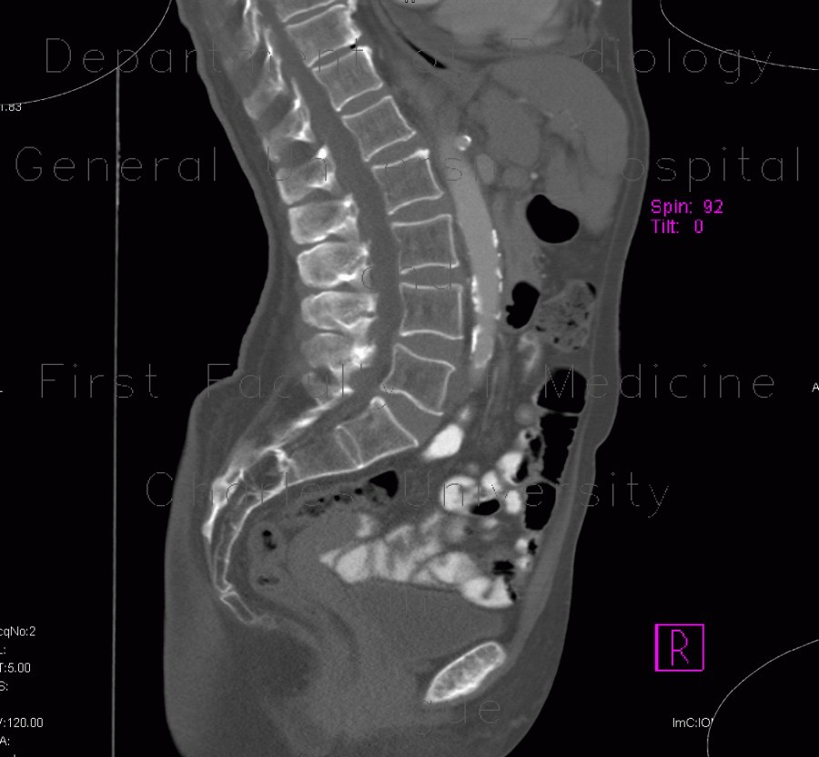 Radiology image - Tarlov cyst, calcified: Spine and Axial, Bone, Brain: CT - Computed tomography