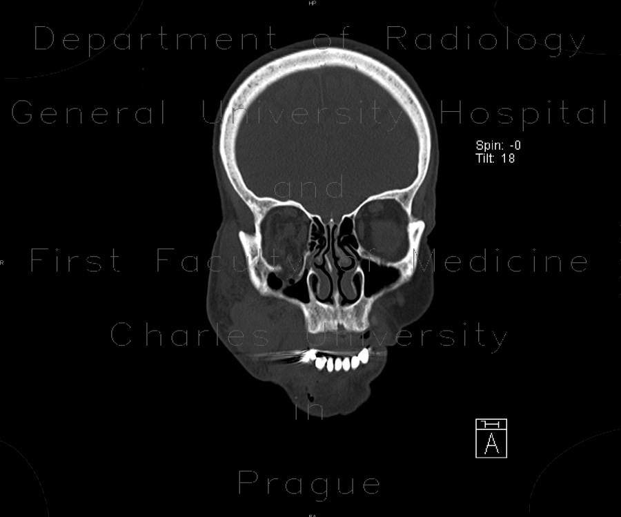 Radiology image - Teardrop figure, orbital floor fracture, blow-out fracture: Head and Neck, Bone, Orbit, Sinuses: CT - Computed tomography
