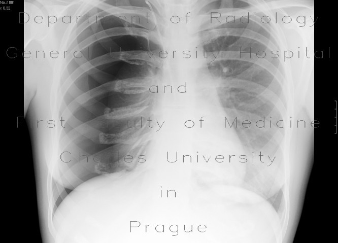 Tension pneumothorax