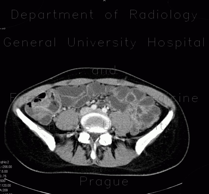 Terminal ileitis