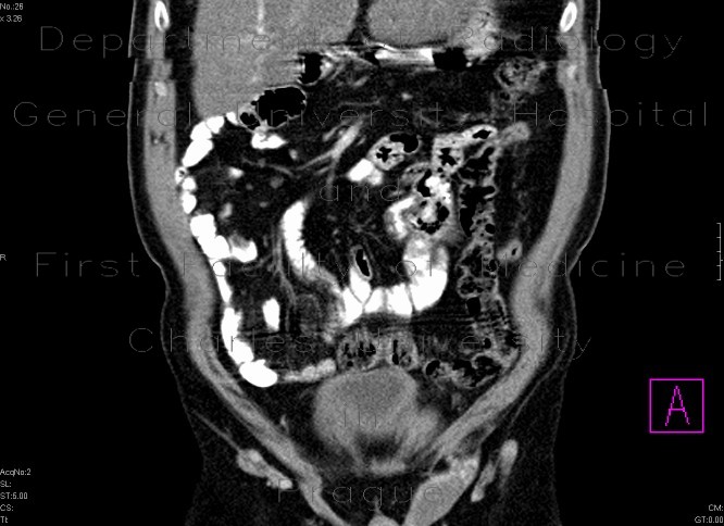 Testicular retention in the inquinal canal