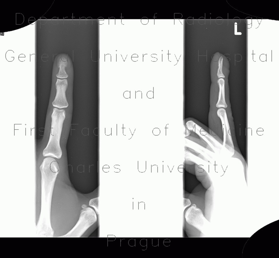 Radiology image - Thickening of nail bed: Extremity, Soft tissue: X-ray - Plain radiograph