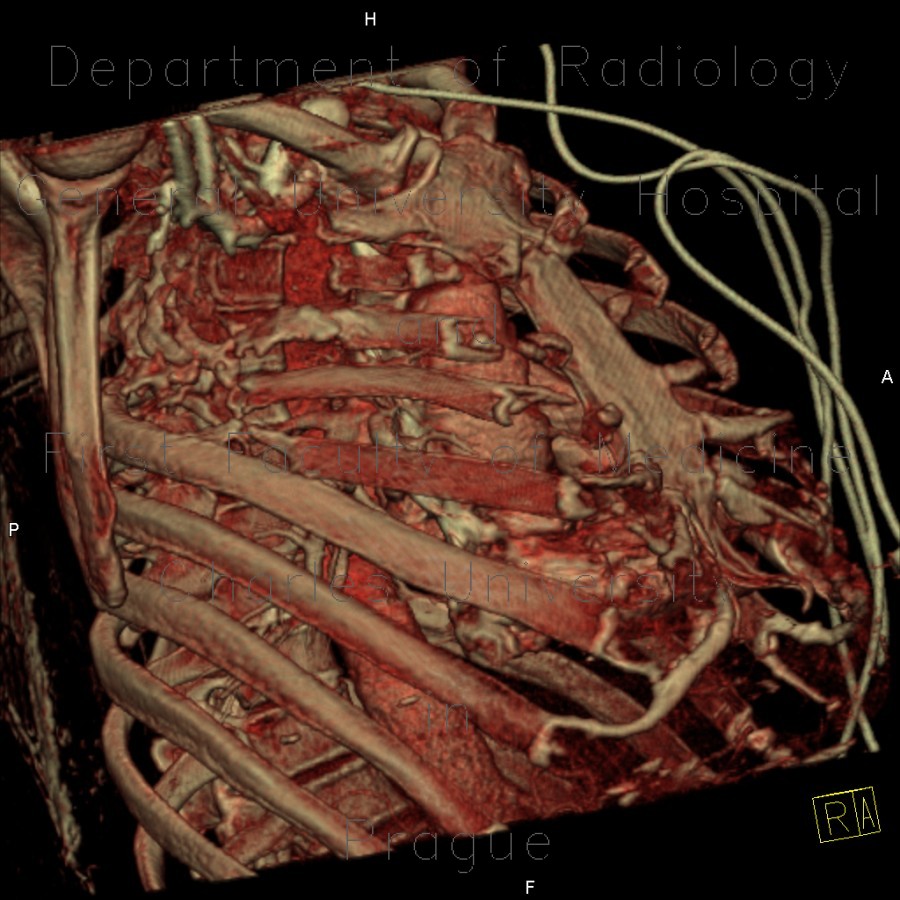 Thoracoplasty, VRT