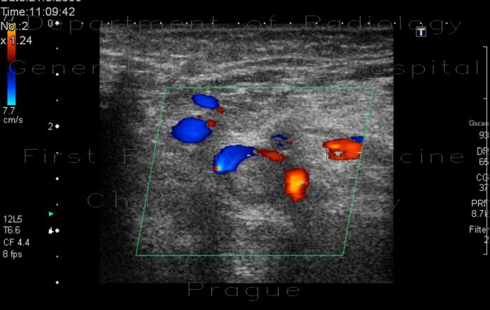 Thrombosis of femoral vein