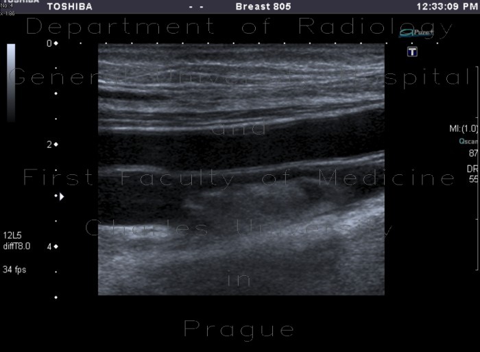 Radiology image - Thrombosis of femoral vein, subacute: Extremity, Vessels: US - Ultrasound