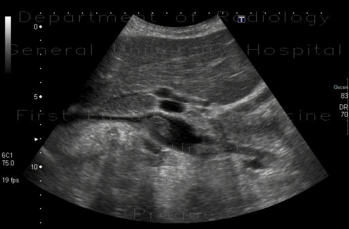 Radiology image - Thrombosis of inferior vena cava: Abdomen, Vessels: US - Ultrasound