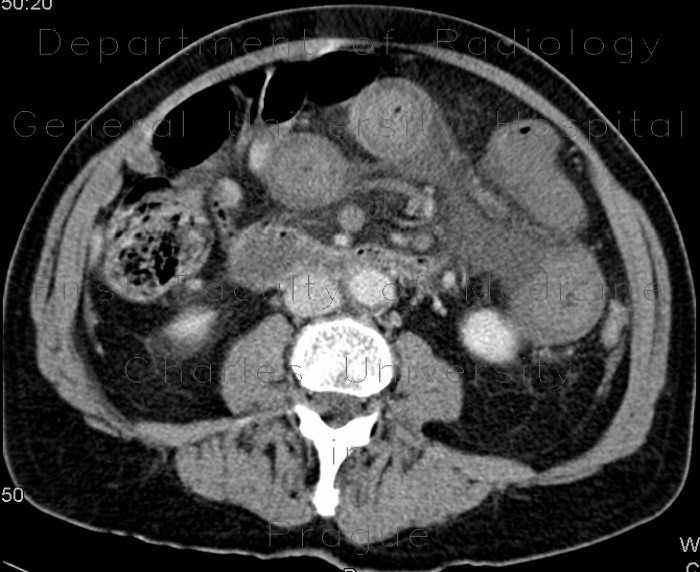 Radiology image - Thrombosis of mesenteric and portal vein, venous infarction of small bowel loops: Abdomen, Liver, Peritoneal cavity, Small bowel, Vessels: CT - Computed tomography