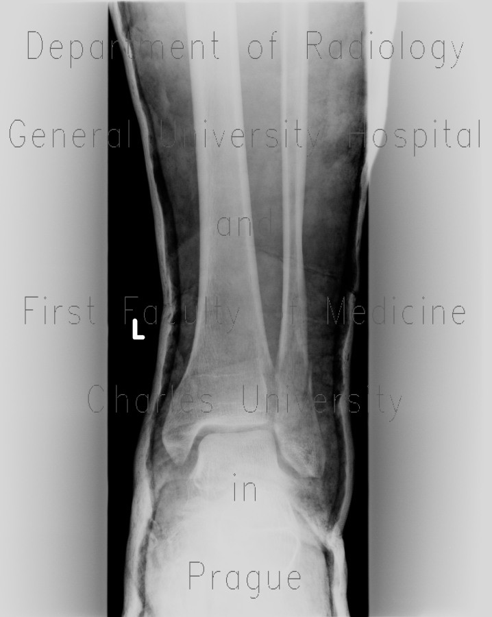 Thrombosis of muscular veins of the calf, fracture of the fibular ankle and plaster cast