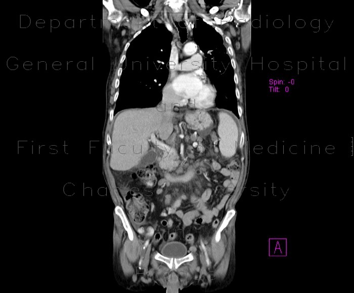 Radiology image - Thrombosis of portal and mesenteric vein: Abdomen, Vessels: CT - Computed tomography