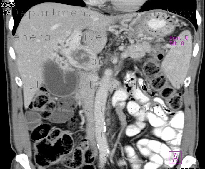 Thrombosis of portal vein