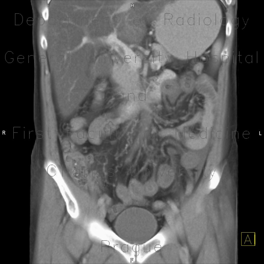 Radiology image - Thrombosis of superior mesenteric vein, infarsation of small bowel: Abdomen, Peritoneal cavity, Small bowel, Vessels: CT - Computed tomography