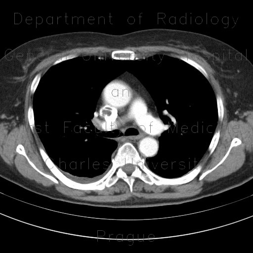 Radiology image - Thrombosis of superior vena cava: Thorax, Vessels: CT - Computed tomography