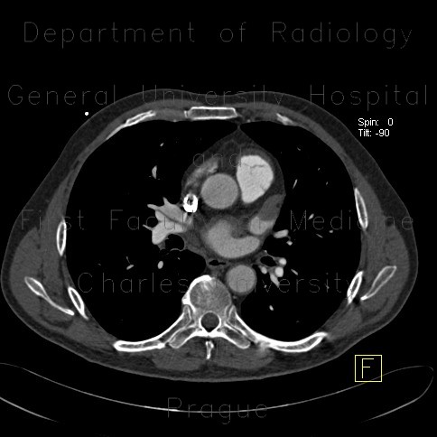 Radiology image - Thrombosis of the left atrial appendage: Thorax, Heart: CT - Computed tomography