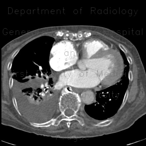 Radiology image - Thrombosis of the pulmonary vein: Thorax, Vessels: CT - Computed tomography