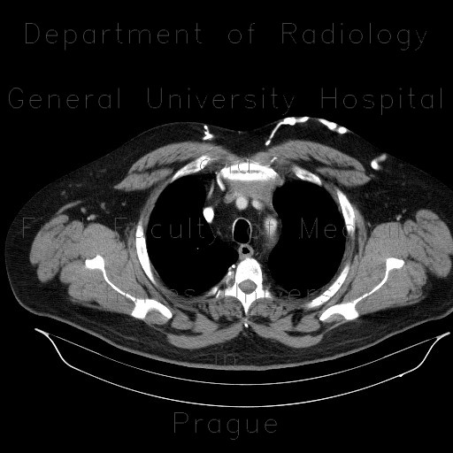 Radiology image - Thymoma, compression of the brachiocephalic vein, collateral flow: Thorax, Mediastinum and pleural cavity, Vessels: CT - Computed tomography