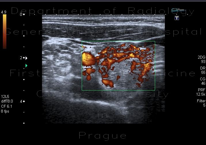 Radiology image - Thyroid nodule: Head and Neck, Thyroid and Parathyroids: US - Ultrasound