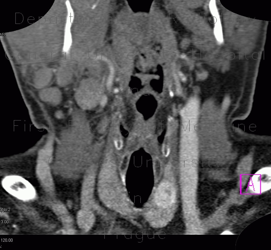 Thyroid nodule, enhancing