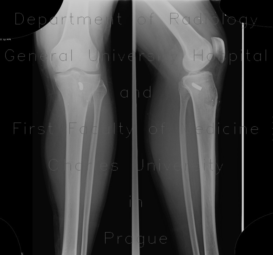 Tibia foreign body gun shot wound