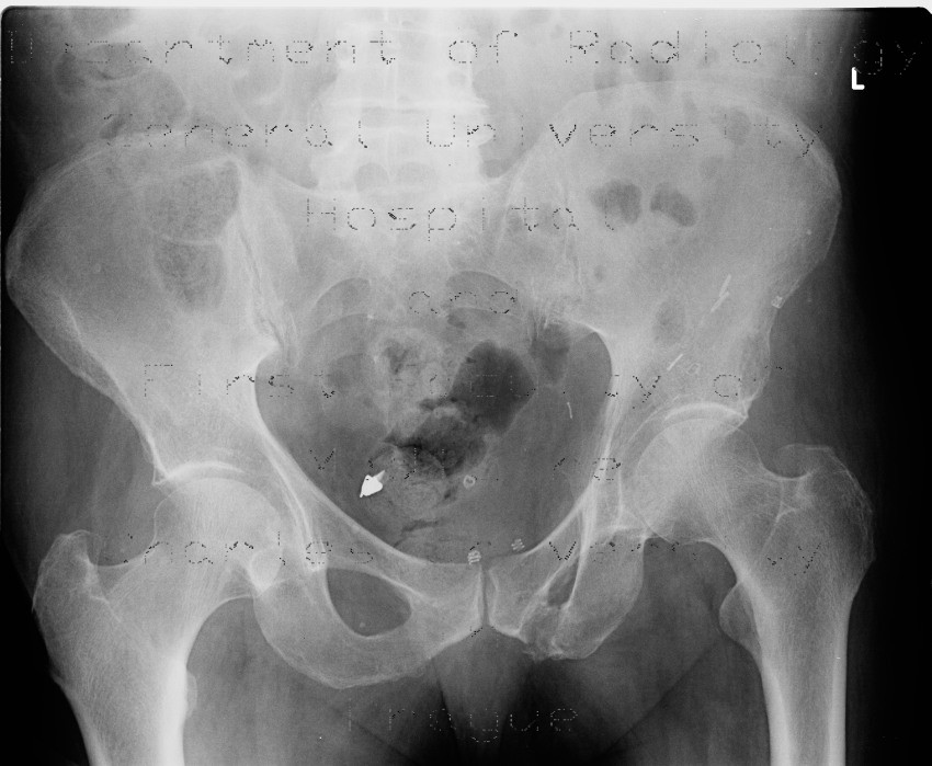 Tooth in sigmoid colon