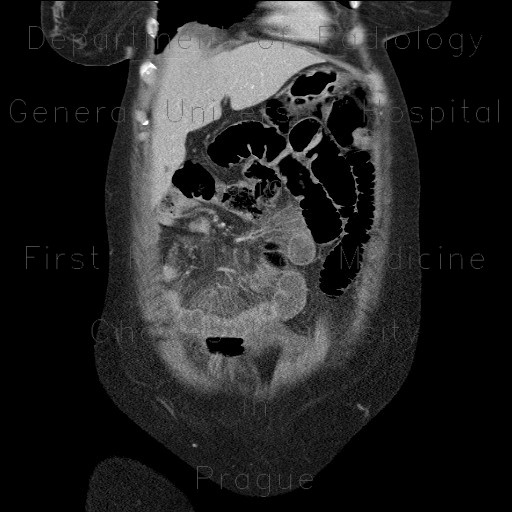 Torsion of the mesentery