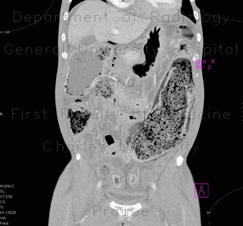 Radiology image - Toxic megacolon, pneumoperitoneum: Abdomen, Large bowel: CT - Computed tomography
