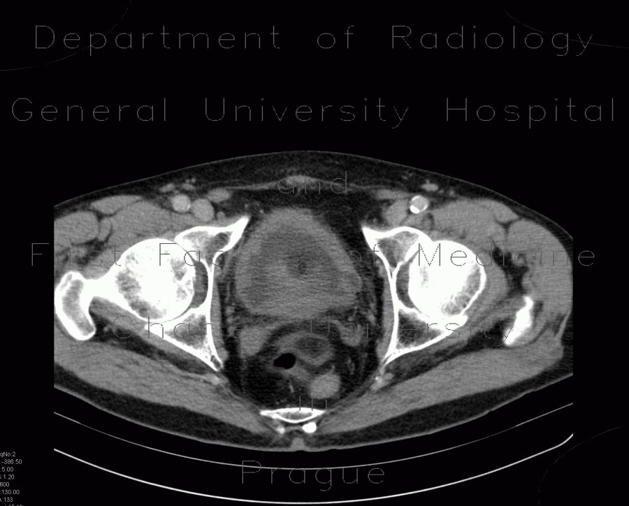 Radiology image - Trabecular hypertrophy of bladder, trabeculated bladder, pseudodiverticula: Abdomen, Urinary tract: CT - Computed tomography