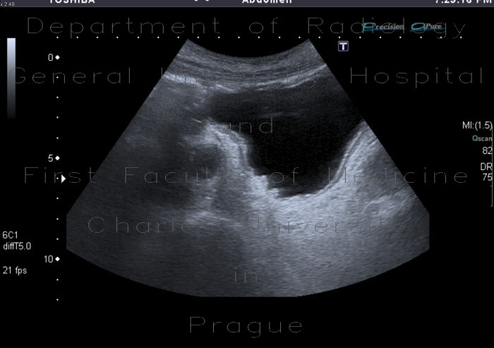 Radiology image - Trabecular hypertrophy of bladder wall: Abdomen, Urinary tract: US - Ultrasound