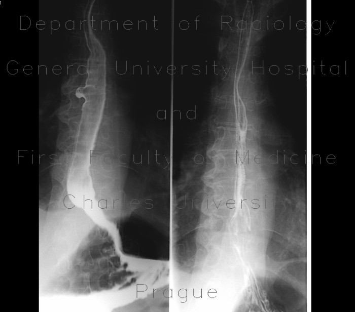 Radiology image - Traction diverticulum of oesophagus: Thorax, Oesophagus: RF - Fluoroscopy