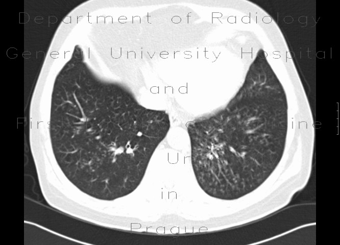 Tree in bud pattern, infectious bronchiolitis