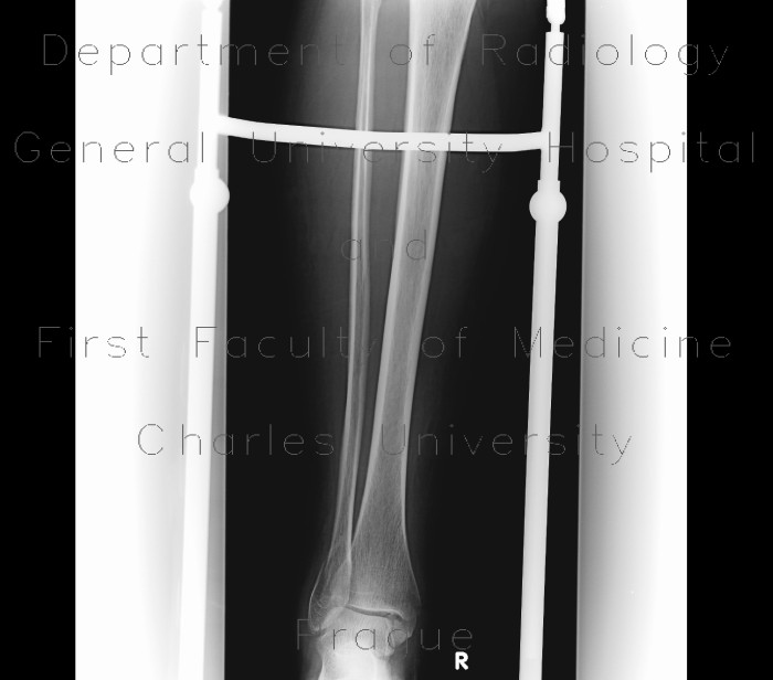 Trimalleolar fracture, subluxation in talocrural joint