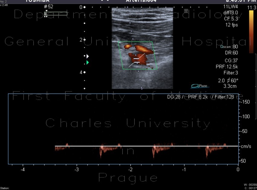 Trombembolus of axillary artery