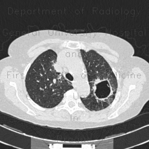 Tuberculosis, pulmonary tuberculosis, cavern